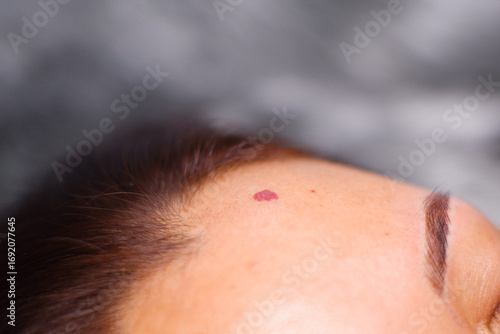 Cherry Angioma on the face.