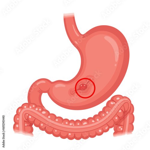 Detailed Medical Illustration of a Gastric Ulcer in the Human Stomach and Duodenum with Highlighted Affected Area