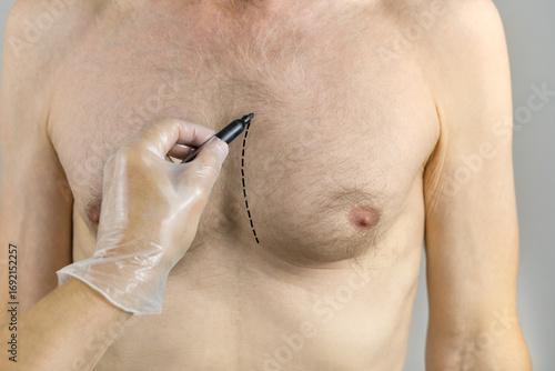 Plastic surgeon draws surgical plans before male breast reduction