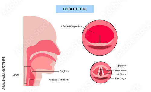 Epiglottitis medical poster