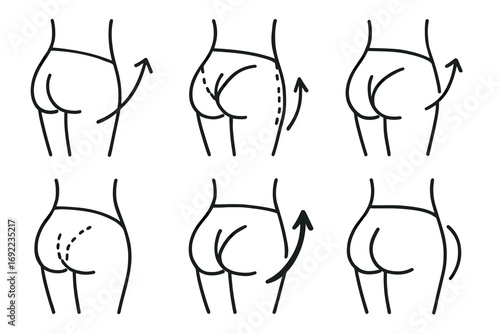 Buttocks enhancement illustration: cosmetic surgery options and techniques