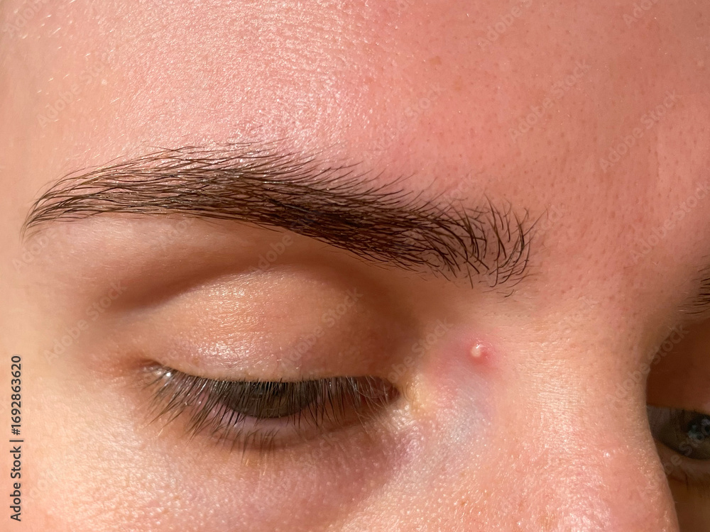 Obraz premium Detailed macro photo of inflamed pimple near eyebrow. Ideal for skincare, cosmetic issues, dermatology concepts, and educational visual materials.