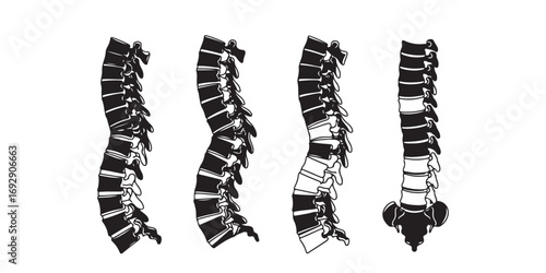 A stark black and white illustration depicting four human spinal columns, each exhibiting distinct curves and potential abnormalities.