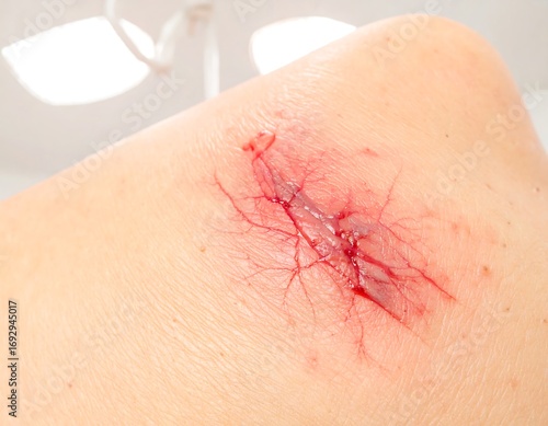 A bloody, open wound on a light-skinned knee
