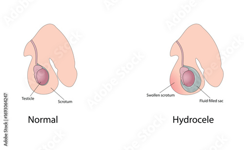 Hydrocele vector illustration