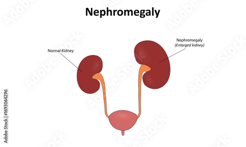 Nephromegaly (Enlarged kidney) vector illustration