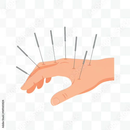 Illustration of acupuncture needles inserted into the back of a hand, representing alternative medicine and therapeutic treatment
