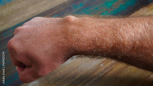 Photos Ganglion cyst on man's hand