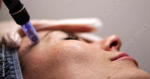 Cosmetic procedure microneedling. Facial skin care. A woman undergoes a procedure for restoring and regenerating facial skin. A cosmetologist works in a cosmetic office.
