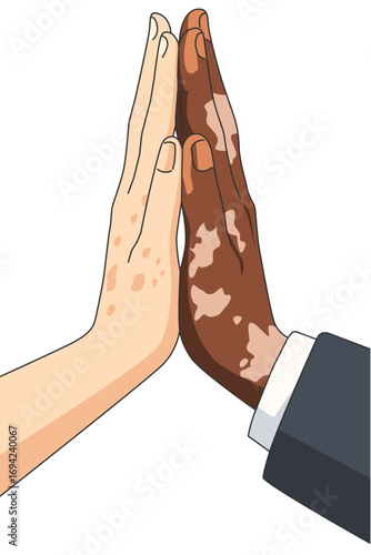Portrait vitiligo sufferer giving a high five with different skin tones. Unique skin pigmentation highlighting natural beauty. World vitiligo day. Skin depigmentation, skin disorder.