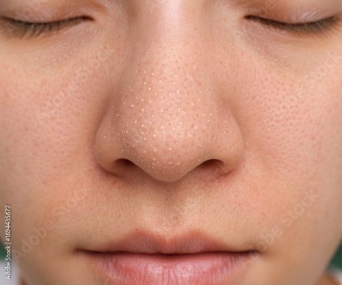 Close Up of Nose with Whiteheads and Clogged Pores