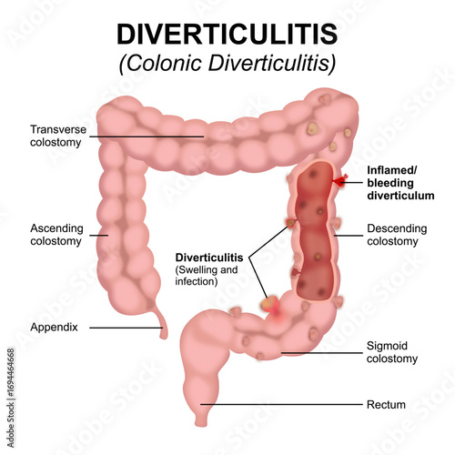 Diverticulitis - Colonic Diverticulitis flashcard illustration
