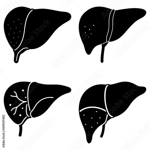 A collection of four liver illustrations showing different conditions and anatomical variations precisely