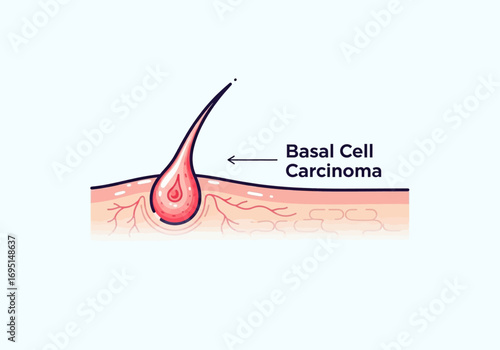 Basal Cell Carcinoma Skin Cancer Illustration with Hair Follicle