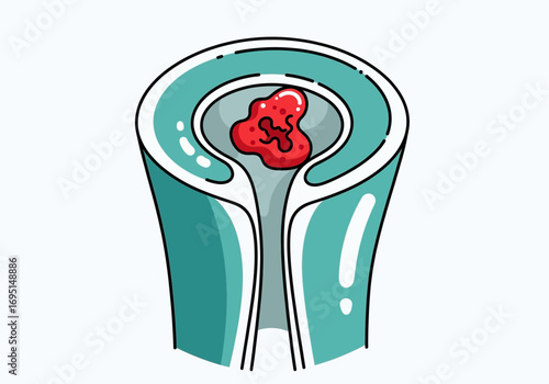 Medical illustration depicting a severe internal obstruction, possibly a blood clot or abnormal growth, causing a blockage within a tubular structure or blood vessel