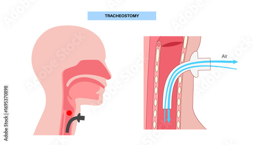 Tracheostomy medical poster