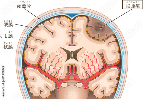 脳腫瘍のイラスト Brain tumor illustration