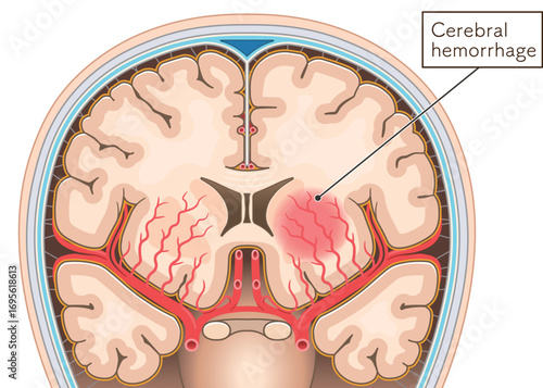 脳出血のイラスト Illustration of cerebral hemorrhage