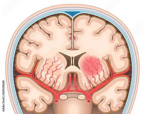 脳出血のイラスト Illustration of cerebral hemorrhage