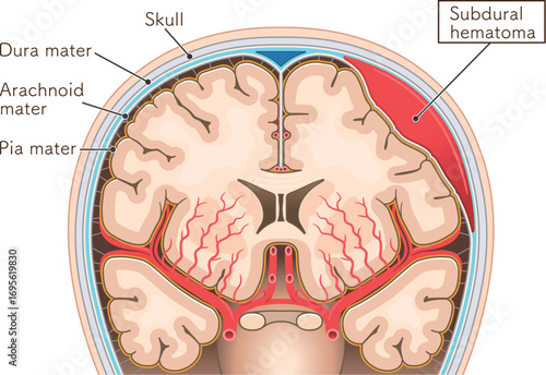 硬膜下血腫のイラスト Illustration of subdural hematoma