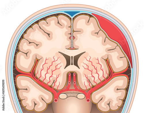 硬膜下血腫のイラスト Illustration of subdural hematoma