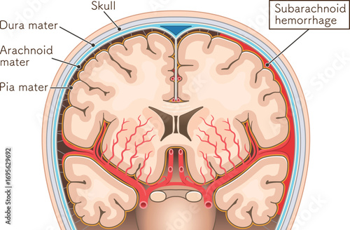 くも膜下出血のイラスト Illustration of subarachnoid hemorrhage
