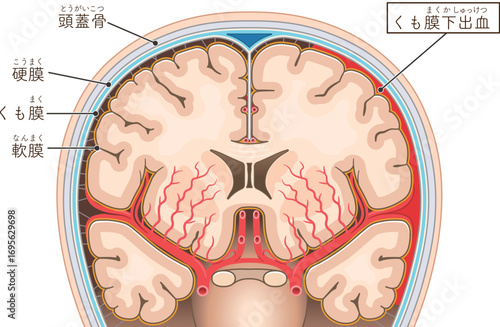 くも膜下出血のイラスト Illustration of subarachnoid hemorrhage