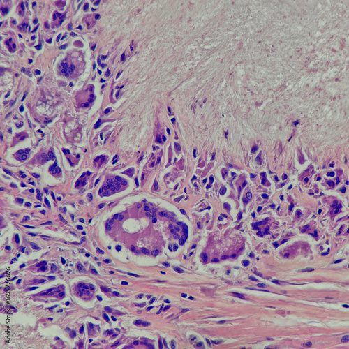 Camera photo of gouty tophi with foreign body reaction at periphery, magnification 400x, photograph through a microscope