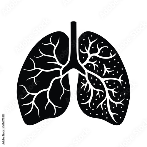 Lung Cancer Metastasis to Brain Illustration