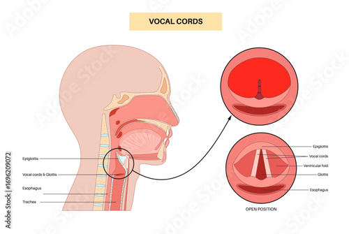 Epiglottitis medical poster