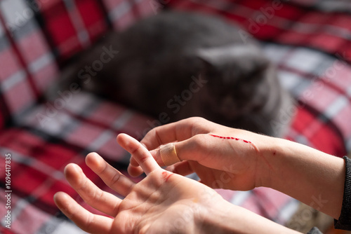 Scratches on a hand after playing with a cat resting on a sofa. Close-up of a child's hand with scratches and a bandage after playing with a cat dozing in the background