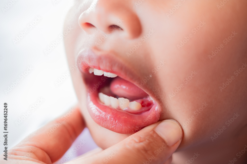 Obraz premium Close up of a child’s open mouth showing a missing tooth with bleeding gums, representing tooth loss, dental health, oral hygiene, and childhood growth, isolated and detailed.
