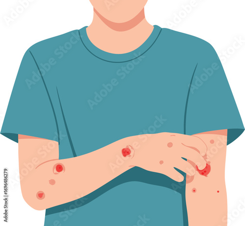 Medical Illustration of Skin Infection with Wounds and Rash on the Arm for Healthcare Education