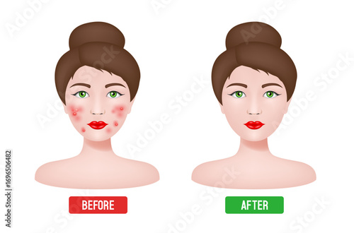Acne skin and clear skin. Before and after. Vector illustration.