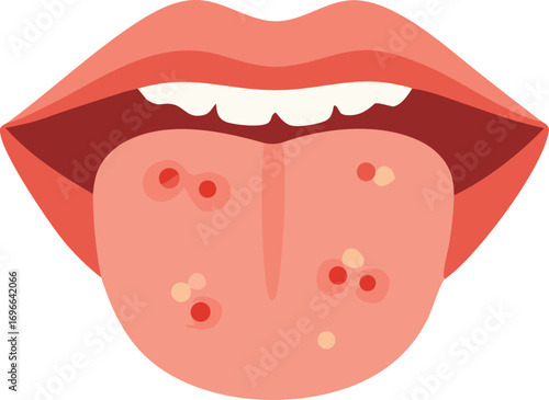 Medical Illustration of Tongue with Visible Sores, Ulcers, and Infections for Oral Health and Disease Awareness