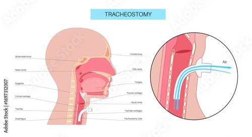 Tracheostomy medical poster