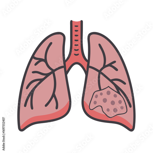 Lung Cancer Illustration Depicting Tumor Growth in the Human Body
