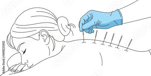 Gentle acupuncture treatment for pain relief and wellness, promoting relaxation