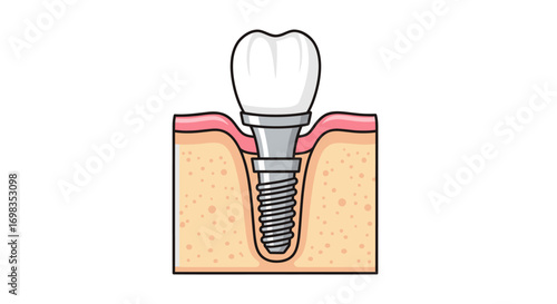 Dental Implant with Crown Cross-Sectional View.
