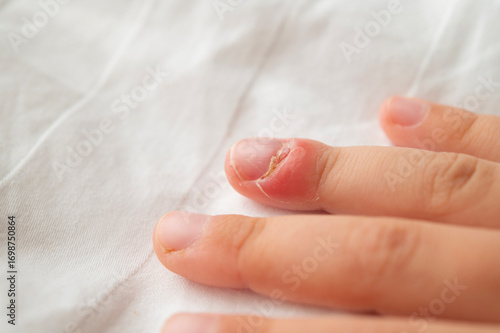 Painful purulent inflammation on a child's finger - paronychia.