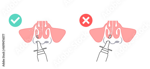 Proper nasal spray usage