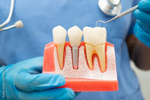 Dentist holding dental implant, artificial tooth roots into jaw, root canal of dental treatment, gum disease, teeth model for dentist.