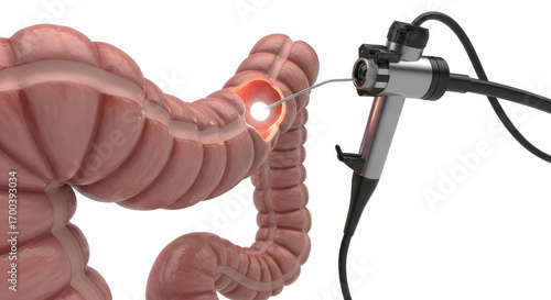Internal View of Colon During Endoscopic Examination Exploring Digestive Health
