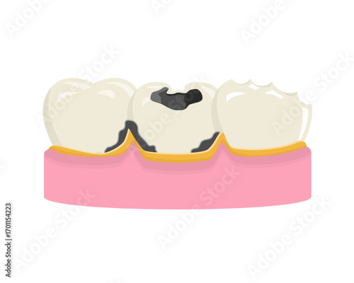 Vector illustration showing various stages of tooth decay, including a large cavity, chipped enamel, and plaque buildup on teeth set in gums