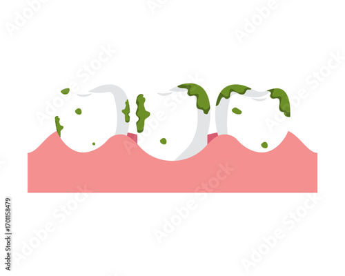 Dental Hygiene Preventing Tooth Decay and Gum Disease