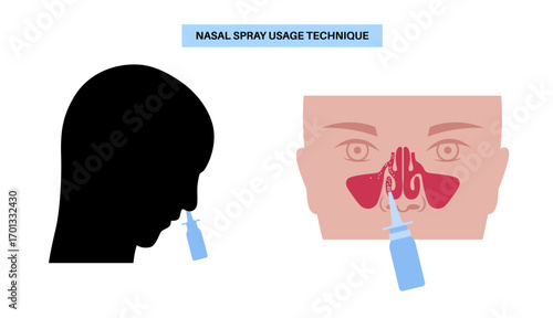 Proper nasal spray usage