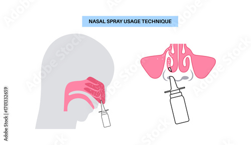 Proper nasal spray usage