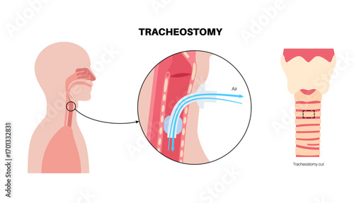 Tracheostomy medical poster
