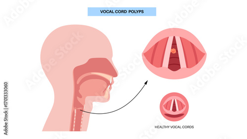 Vocal cord polyps
