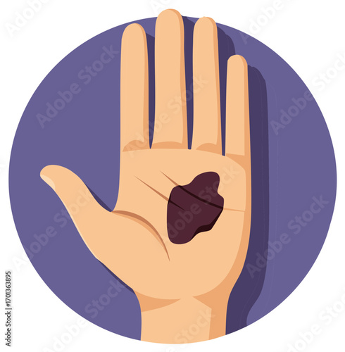 Open human hand showing a large birthmark or mole on the palm flat design icon